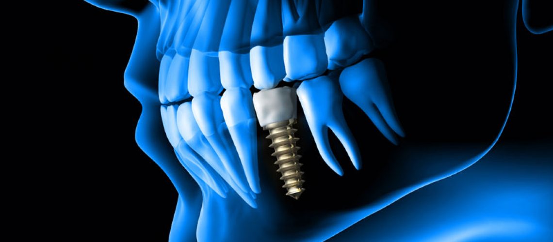 xray visualizing a dental implant that is placed in the premolar